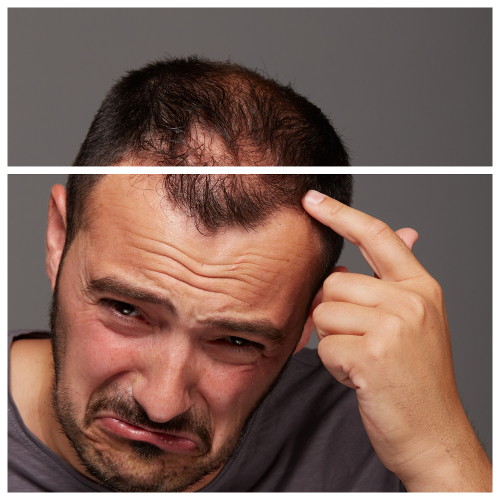 La alopecia androgénica es la forma más común de alopecia, afectando al 50% de los hombres.