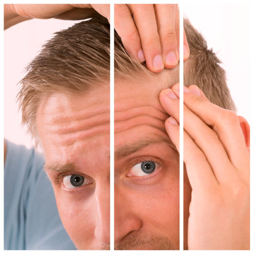 Los tipos de alopecia se diferencian entre cicatriciales y no cicatriciales.